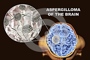 Aspergilloma of the brain and close-up view of fungi Aspergillus