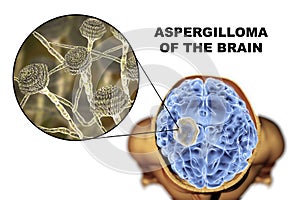 Aspergilloma of the brain and close-up view of fungi Aspergillus