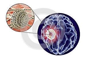 Aspergilloma of the brain and close-up view of fungi Aspergillus