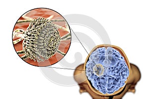 Aspergilloma of the brain and close-up view of fungi Aspergillus