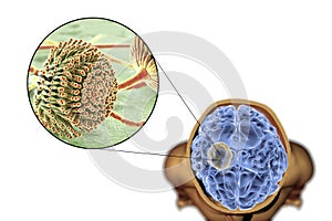 Aspergilloma of the brain and close-up view of fungi Aspergillus