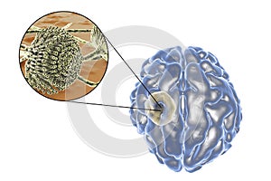 Aspergilloma of the brain and close-up view of fungi Aspergillus photo