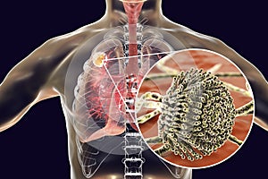 Aspergilloma of the lung photo