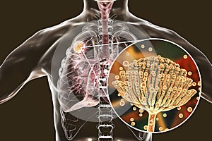 Aspergilloma of the lung photo