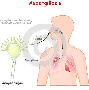 Aspergillosis. life cycle of pathogenic flora photo