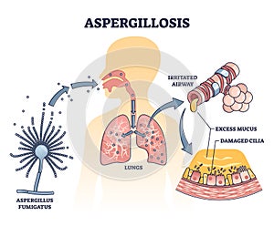 Aspergillosis lung infection caused by Aspergillus, vector outline diagram