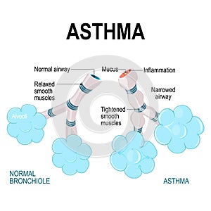 Asthma. alveoli and bronchiole.