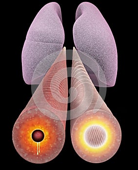 Asthma, bronchial section, lung