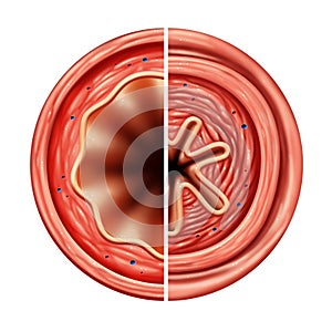 Asthma Bronchial Tube