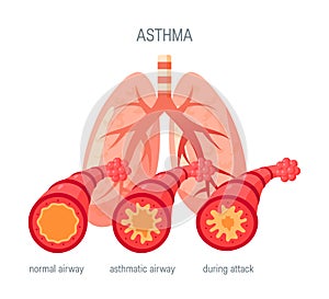 Asthma disease vector icon in flat style photo