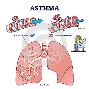 Asthma health condition compared normal and inflamed airway outline diagram