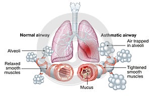 Asthma, normal and asthmatic airways, medically illustration