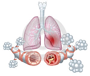 Asthma, normal and asthmatic airways, medically illustration