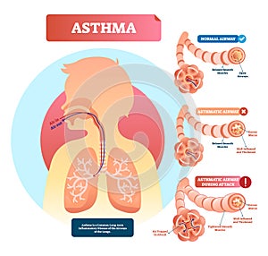 Asthma vector illustration. Disease with breathing problems diagram..