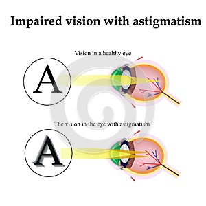 Astigmatism. As the eye can see with astigmatism. Impaired vision