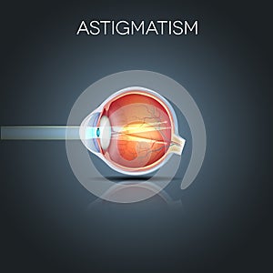 Astigmatism, blurred vission photo