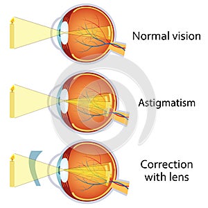 Astigmatism corrected by a cylindrical lens. photo