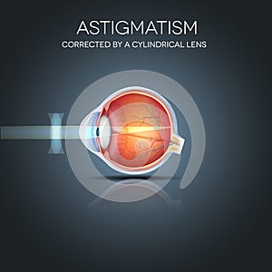 Astigmatism corrected by a cylindrical lens photo
