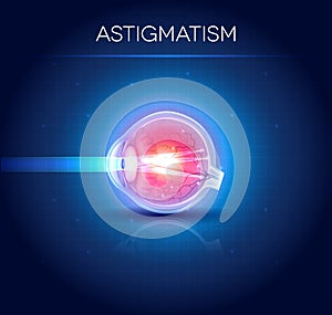 Astigmatism eyesight disorder photo