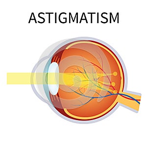 Astigmatism. Eyesight problem, blurred vision.