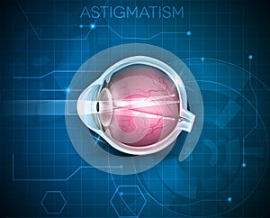 Astigmatism, eyesight problem photo