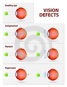 Astigmatism, Myopia and Hyperopia photo