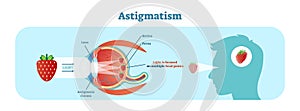 Astigmatism vector illustration diagram, anatomical scheme. photo