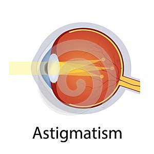 Astigmatism and Vision Disorders Illustration. Eyes Defect Concept. Detailed Anatomy Eyeball with Astigmatism Defect