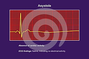 ECG in asystole, 3D illustration photo