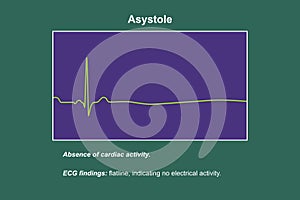 ECG in asystole, 3D illustration photo