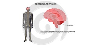 Ataxia cerebellar disorder