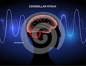 Ataxia cerebellar disorder