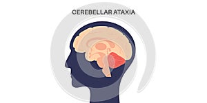 Ataxia cerebellar disorder photo