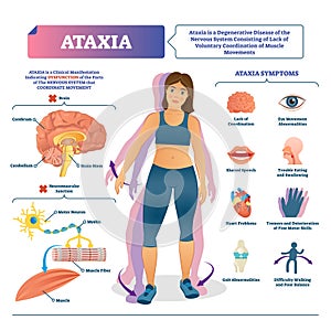 Ataxia vector illustration. Labeled medical movement brain disorder scheme.