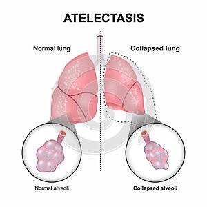 Atelectasis Collapsed Lung