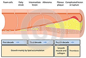 Atheroma formation