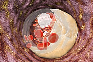 Atheroma plaque inside artery photo