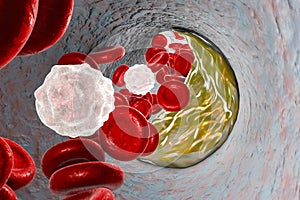 Atheroma plaque inside artery photo