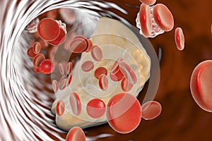 Atheroma plaque inside artery photo