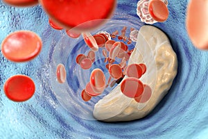Atheroma plaque inside artery photo