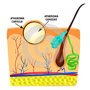 Atheroma structure. The structure of moles on the skin. Infographics. Vector illustration on isolated background. photo