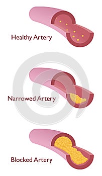 Atherosclerosis photo