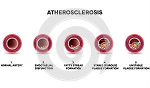 Atherosclerosis