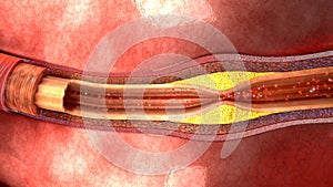 Atherosclerosis