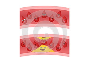 Atherosclerosis anime icon vector / fat stuck in the blood artery cholesterol