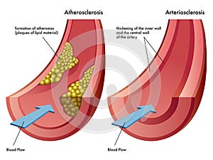 Atherosclerosis & Arteriosclerosis
