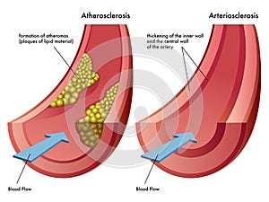 Atherosclerosis & Arteriosclerosis photo