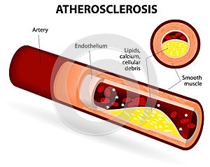Ateroskleróza 