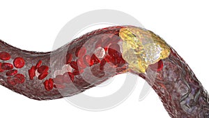 Atherosclerosis, atheromatous plaque inside artery