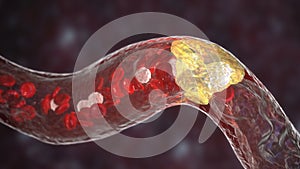 Atherosclerosis, atheromatous plaque inside artery
